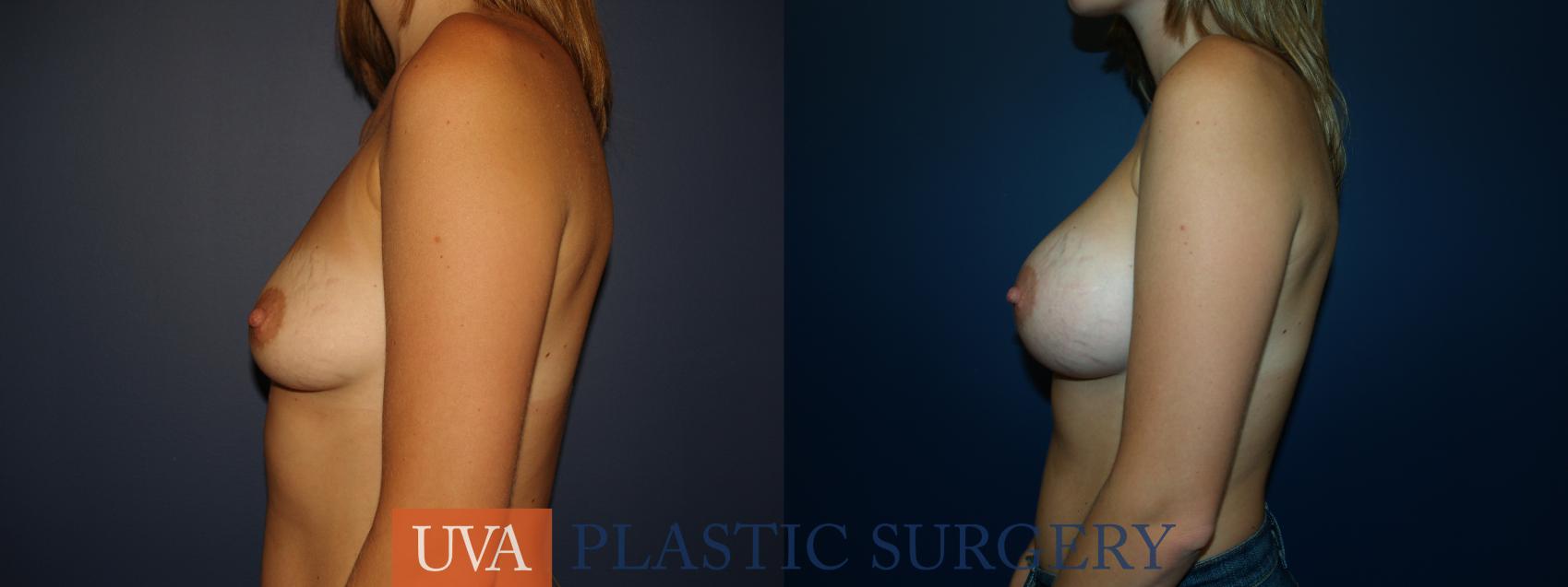 Breast Augmentation Case 21 Before & After View #5 | Charlottesville & Fishersville, VA | University of Virginia Plastic Surgery