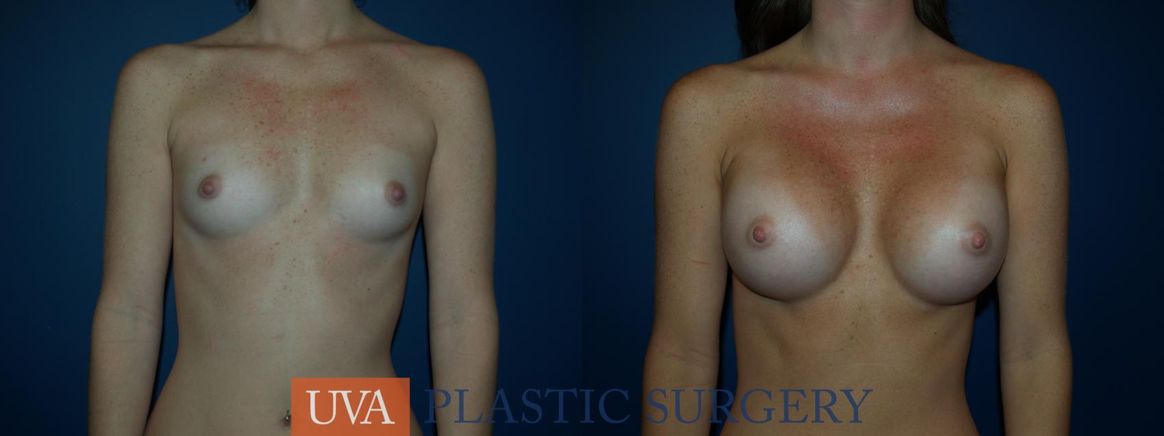 Breast Augmentation Case 22 Before & After View #1 | Charlottesville & Fishersville, VA | University of Virginia Plastic Surgery