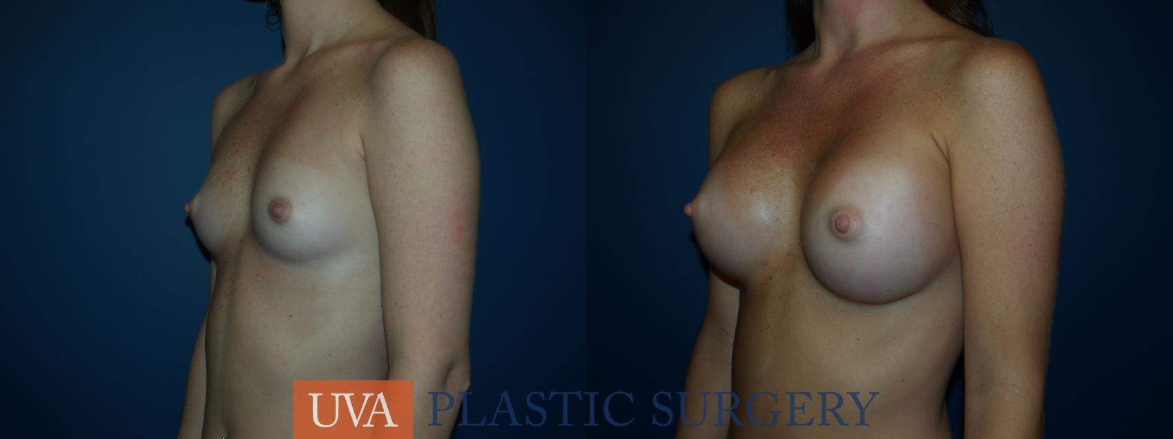 Breast Augmentation Case 22 Before & After View #3 | Charlottesville & Fishersville, VA | University of Virginia Plastic Surgery