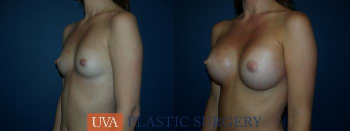 Breast Augmentation Case 22 Before & After View #3 | Richmond, Charlottesville & Roanoke, VA | University of Virginia Plastic Surgery