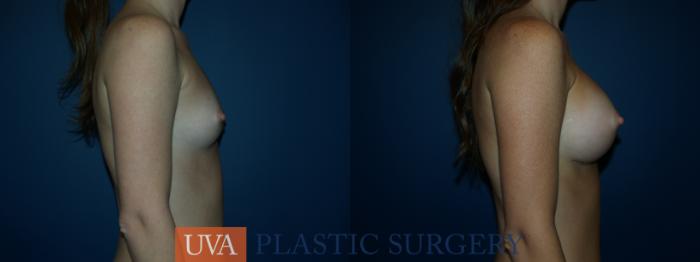 Breast Augmentation Case 22 Before & After View #4 | Richmond, Charlottesville & Roanoke, VA | University of Virginia Plastic Surgery