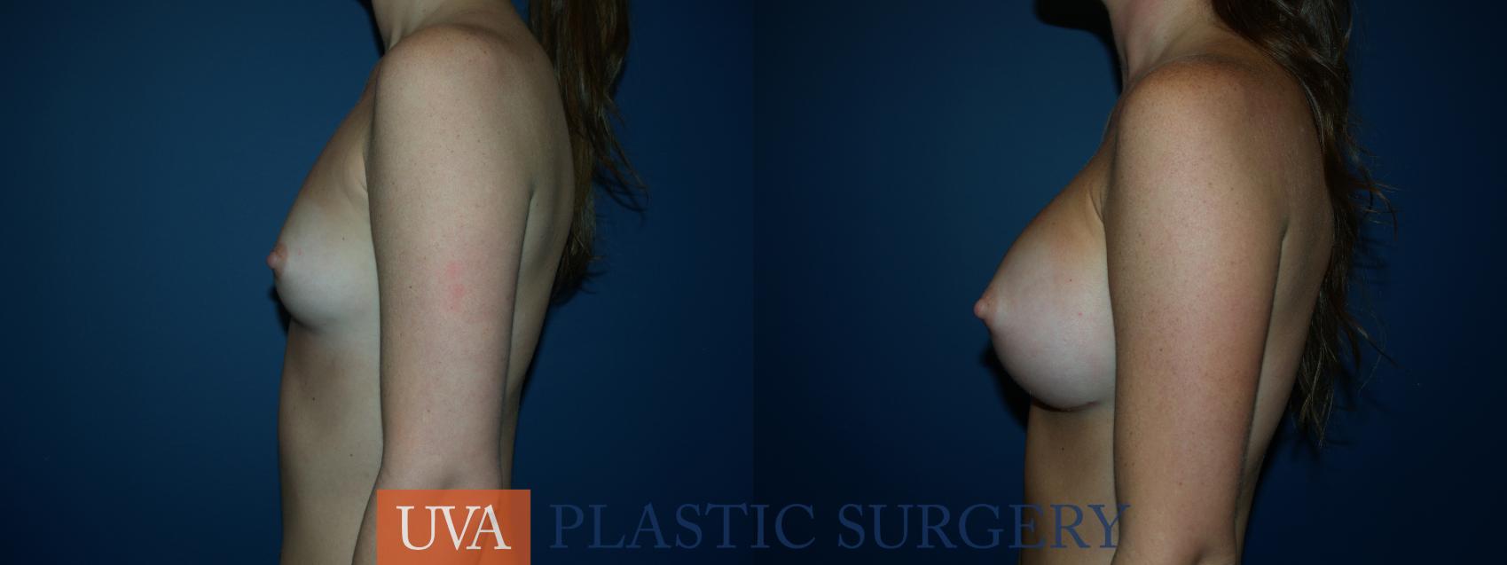 Breast Augmentation Case 22 Before & After View #5 | Charlottesville & Fishersville, VA | University of Virginia Plastic Surgery