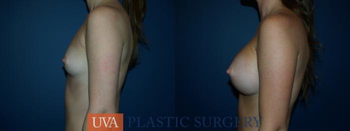 Breast Augmentation Case 22 Before & After View #5 | Richmond, Charlottesville & Roanoke, VA | University of Virginia Plastic Surgery