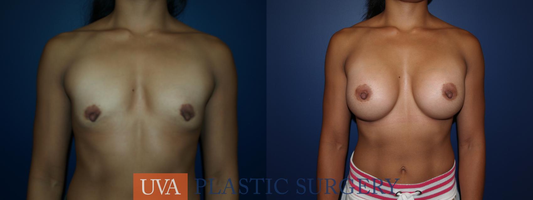 Breast Augmentation Case 23 Before & After View #1 | Charlottesville & Fishersville, VA | University of Virginia Plastic Surgery
