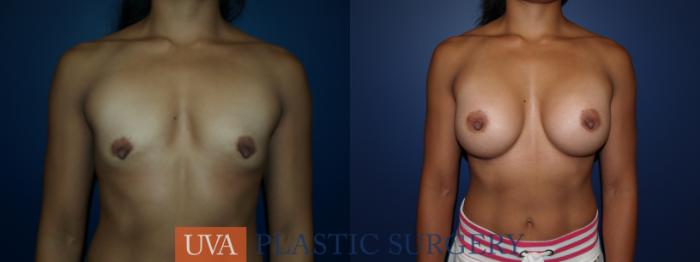 Breast Augmentation Case 23 Before & After View #1 | Richmond, Charlottesville & Roanoke, VA | University of Virginia Plastic Surgery