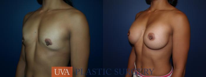 Breast Augmentation Case 23 Before & After View #3 | Richmond, Charlottesville & Roanoke, VA | University of Virginia Plastic Surgery