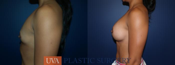Breast Augmentation Case 23 Before & After View #5 | Richmond, Charlottesville & Roanoke, VA | University of Virginia Plastic Surgery