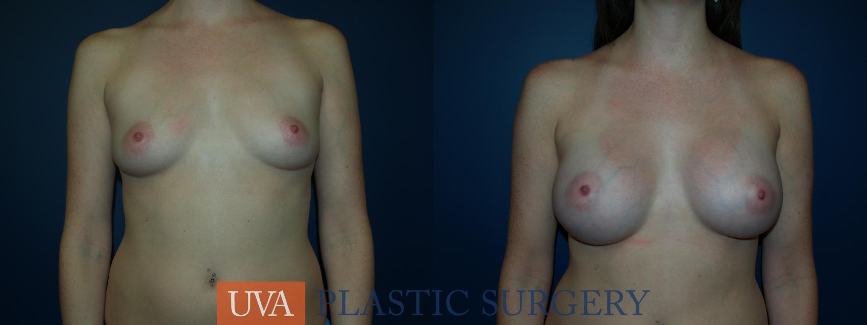 Breast Augmentation Case 24 Before & After View #1 | Charlottesville & Fishersville, VA | University of Virginia Plastic Surgery