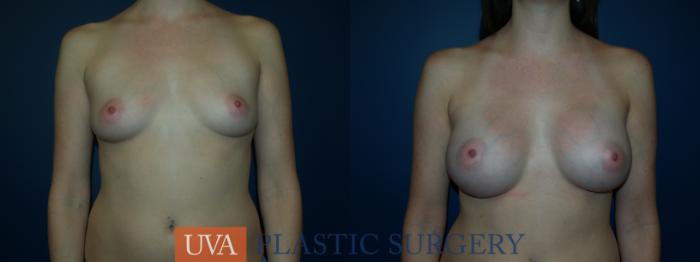 Breast Augmentation Case 24 Before & After View #1 | Richmond, Charlottesville & Roanoke, VA | University of Virginia Plastic Surgery