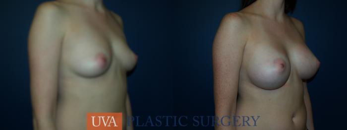 Breast Augmentation Case 24 Before & After View #2 | Richmond, Charlottesville & Roanoke, VA | University of Virginia Plastic Surgery