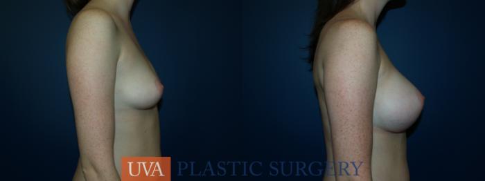 Breast Augmentation Case 24 Before & After View #4 | Richmond, Charlottesville & Roanoke, VA | University of Virginia Plastic Surgery