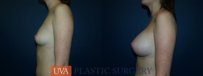 Breast Augmentation Case 24 Before & After View #5 | Richmond, Charlottesville & Roanoke, VA | University of Virginia Plastic Surgery