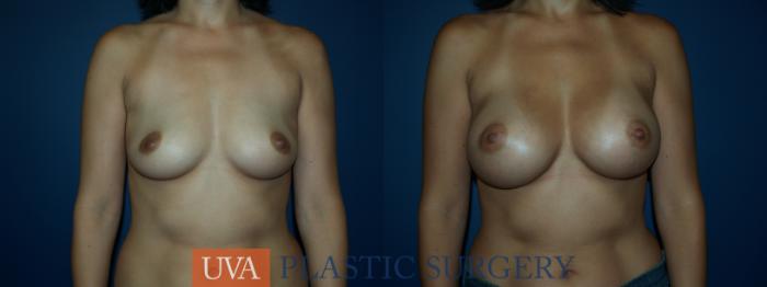 Breast Augmentation Case 25 Before & After View #1 | Richmond, Charlottesville & Roanoke, VA | University of Virginia Plastic Surgery