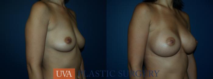 Breast Augmentation Case 25 Before & After View #2 | Richmond, Charlottesville & Roanoke, VA | University of Virginia Plastic Surgery