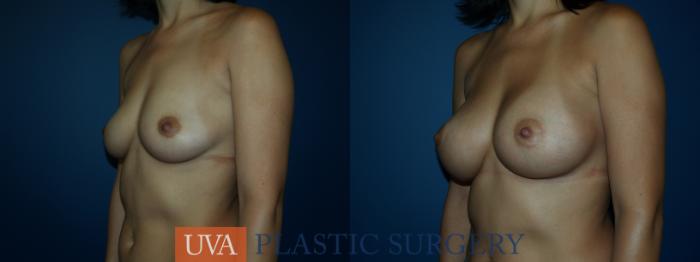 Breast Augmentation Case 25 Before & After View #3 | Richmond, Charlottesville & Roanoke, VA | University of Virginia Plastic Surgery