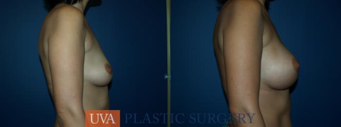 Breast Augmentation Case 25 Before & After View #4 | Richmond, Charlottesville & Roanoke, VA | University of Virginia Plastic Surgery