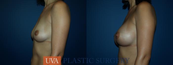 Breast Augmentation Case 25 Before & After View #5 | Richmond, Charlottesville & Roanoke, VA | University of Virginia Plastic Surgery