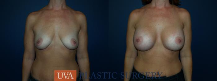 Breast Augmentation Case 26 Before & After View #1 | Richmond, Charlottesville & Roanoke, VA | University of Virginia Plastic Surgery