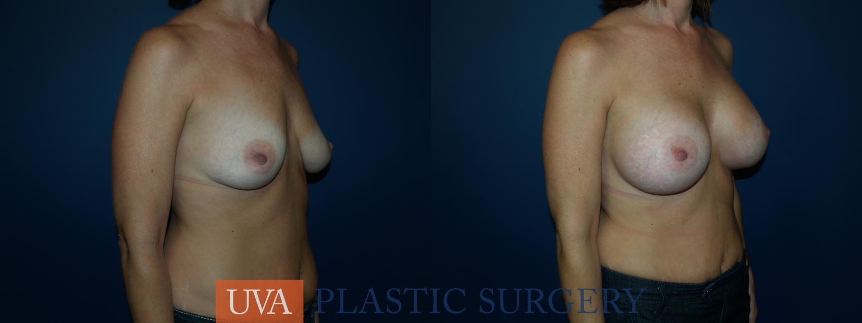 Breast Augmentation Case 26 Before & After View #2 | Charlottesville & Fishersville, VA | University of Virginia Plastic Surgery