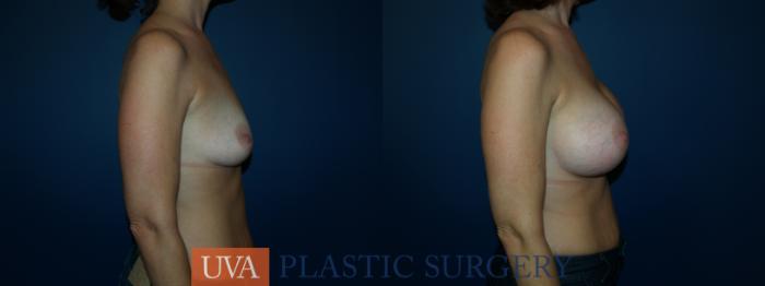 Breast Augmentation Case 26 Before & After View #3 | Richmond, Charlottesville & Roanoke, VA | University of Virginia Plastic Surgery