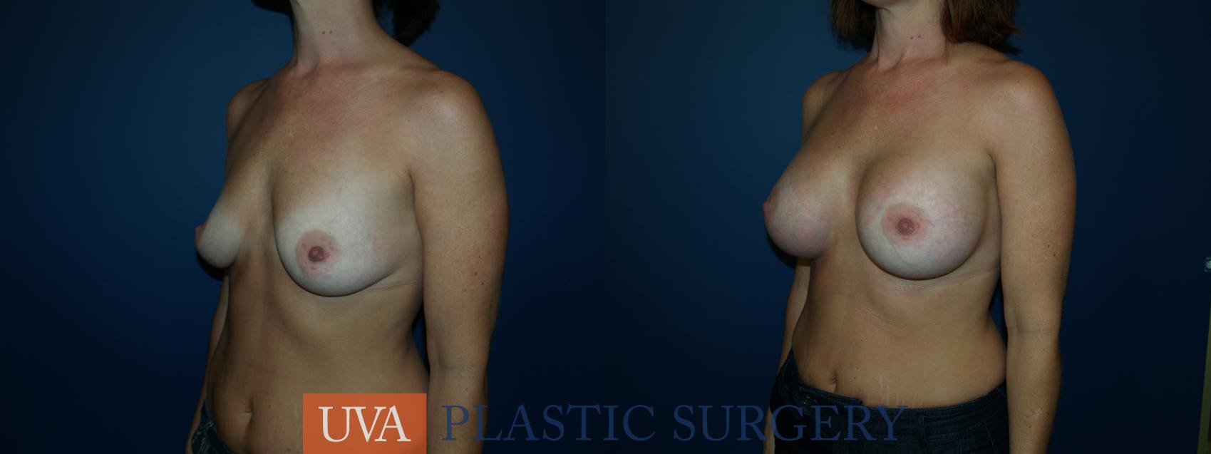 Breast Augmentation Case 26 Before & After View #4 | Charlottesville & Fishersville, VA | University of Virginia Plastic Surgery