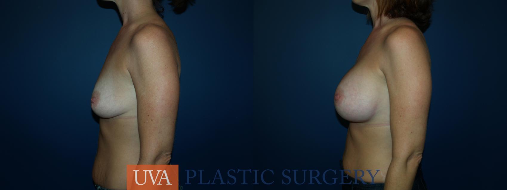 Breast Augmentation Case 26 Before & After View #5 | Charlottesville & Fishersville, VA | University of Virginia Plastic Surgery