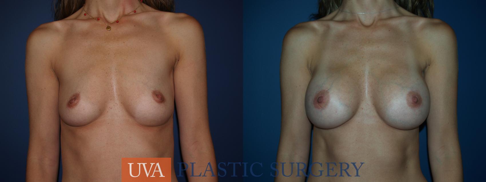 Breast Augmentation Case 27 Before & After View #1 | Charlottesville & Fishersville, VA | University of Virginia Plastic Surgery