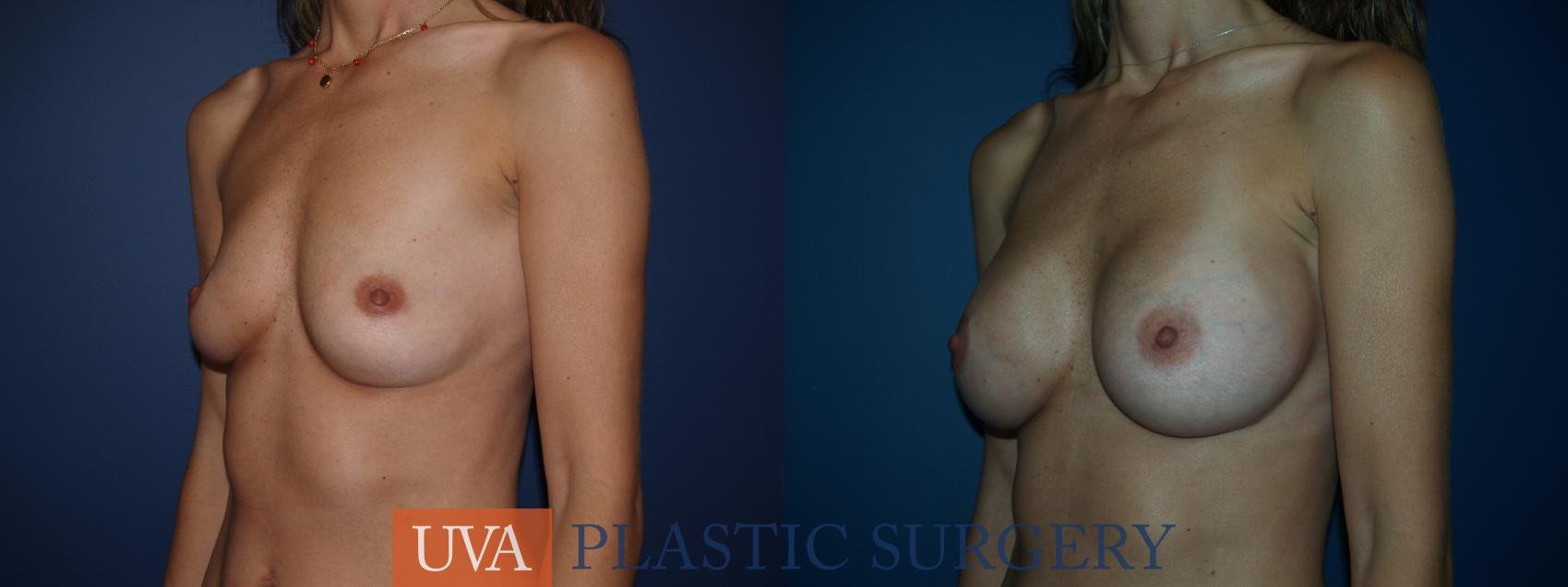Breast Augmentation Case 27 Before & After View #3 | Charlottesville & Fishersville, VA | University of Virginia Plastic Surgery