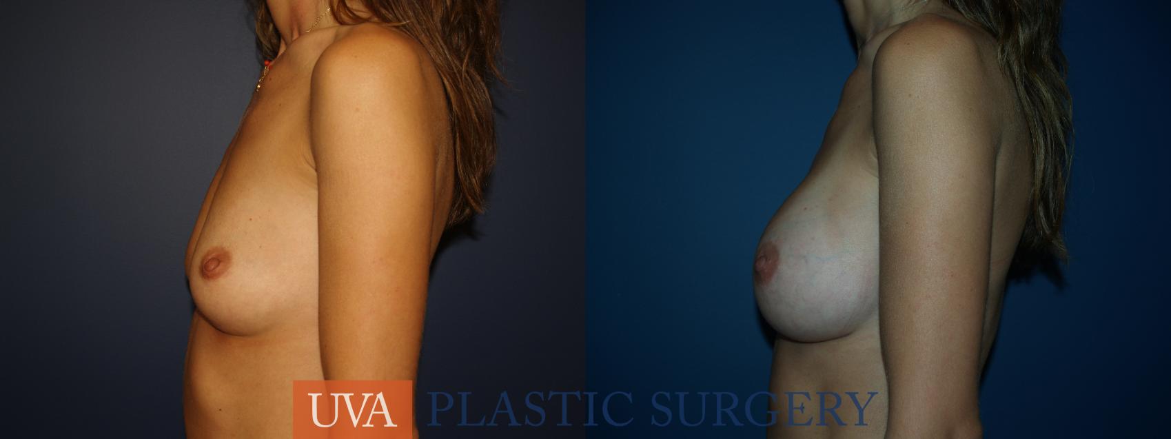Breast Augmentation Case 27 Before & After View #5 | Charlottesville & Fishersville, VA | University of Virginia Plastic Surgery