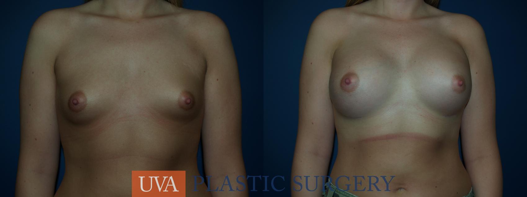 Breast Augmentation Case 29 Before & After View #1 | Charlottesville & Fishersville, VA | University of Virginia Plastic Surgery