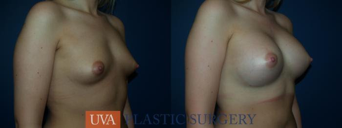 Breast Augmentation Case 29 Before & After View #2 | Richmond, Charlottesville & Roanoke, VA | University of Virginia Plastic Surgery