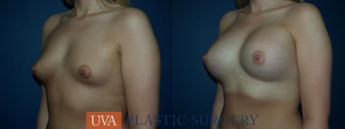 Breast Augmentation Case 29 Before & After View #3 | Richmond, Charlottesville & Roanoke, VA | University of Virginia Plastic Surgery