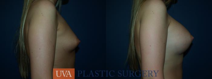Breast Augmentation Case 29 Before & After View #4 | Richmond, Charlottesville & Roanoke, VA | University of Virginia Plastic Surgery