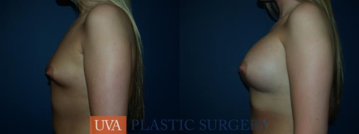 Breast Augmentation Case 29 Before & After View #5 | Richmond, Charlottesville & Roanoke, VA | University of Virginia Plastic Surgery