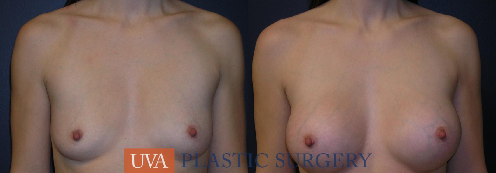 Breast Augmentation Case 30 Before & After View #1 | Richmond, Charlottesville & Roanoke, VA | University of Virginia Plastic Surgery