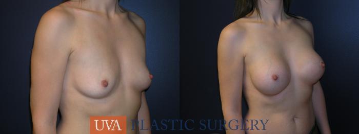 Breast Augmentation Case 30 Before & After View #2 | Richmond, Charlottesville & Roanoke, VA | University of Virginia Plastic Surgery