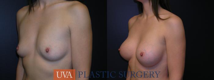 Breast Augmentation Case 30 Before & After View #3 | Richmond, Charlottesville & Roanoke, VA | University of Virginia Plastic Surgery