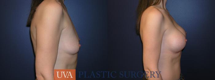 Breast Augmentation Case 30 Before & After View #4 | Richmond, Charlottesville & Roanoke, VA | University of Virginia Plastic Surgery