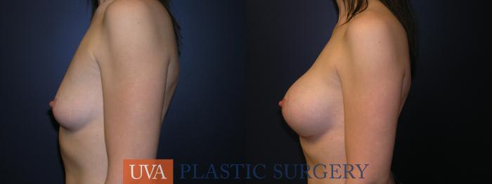 Breast Augmentation Case 30 Before & After View #5 | Richmond, Charlottesville & Roanoke, VA | University of Virginia Plastic Surgery