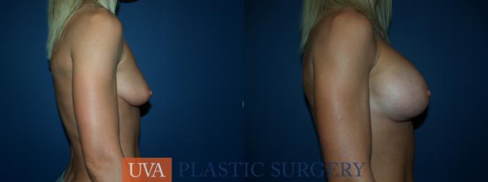 Breast Augmentation Case 32 Before & After View #4 | Richmond, Charlottesville & Roanoke, VA | University of Virginia Plastic Surgery