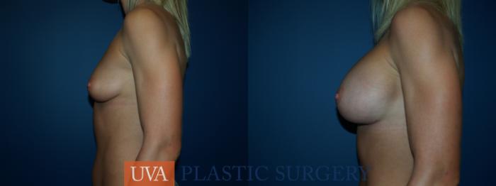 Breast Augmentation Case 32 Before & After View #5 | Richmond, Charlottesville & Roanoke, VA | University of Virginia Plastic Surgery