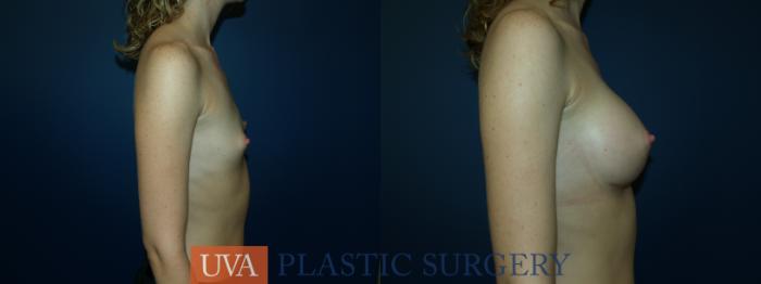 Breast Augmentation Case 33 Before & After View #3 | Richmond, Charlottesville & Roanoke, VA | University of Virginia Plastic Surgery
