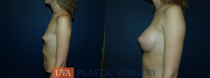Breast Augmentation Case 33 Before & After View #5 | Richmond, Charlottesville & Roanoke, VA | University of Virginia Plastic Surgery