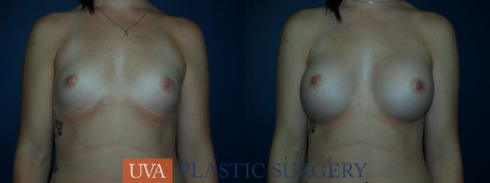 Breast Augmentation Case 34 Before & After View #1 | Richmond, Charlottesville & Roanoke, VA | University of Virginia Plastic Surgery