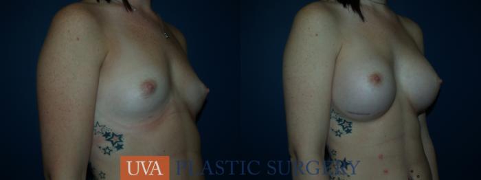 Breast Augmentation Case 34 Before & After View #2 | Richmond, Charlottesville & Roanoke, VA | University of Virginia Plastic Surgery