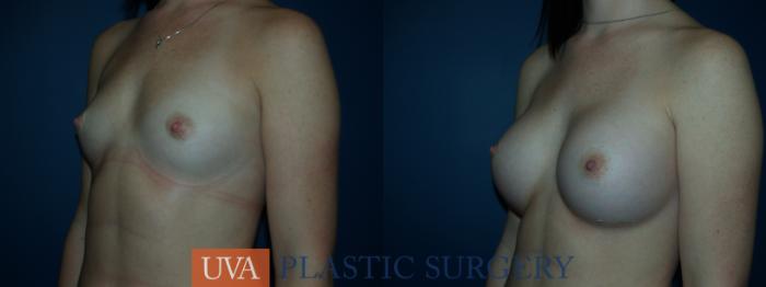 Breast Augmentation Case 34 Before & After View #3 | Richmond, Charlottesville & Roanoke, VA | University of Virginia Plastic Surgery