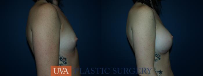 Breast Augmentation Case 34 Before & After View #4 | Richmond, Charlottesville & Roanoke, VA | University of Virginia Plastic Surgery