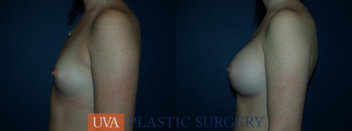 Breast Augmentation Case 34 Before & After View #5 | Richmond, Charlottesville & Roanoke, VA | University of Virginia Plastic Surgery