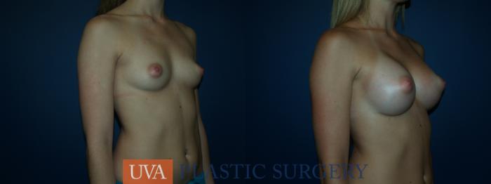 Breast Augmentation Case 37 Before & After View #2 | Charlottesville & Fishersville, VA | University of Virginia Plastic Surgery
