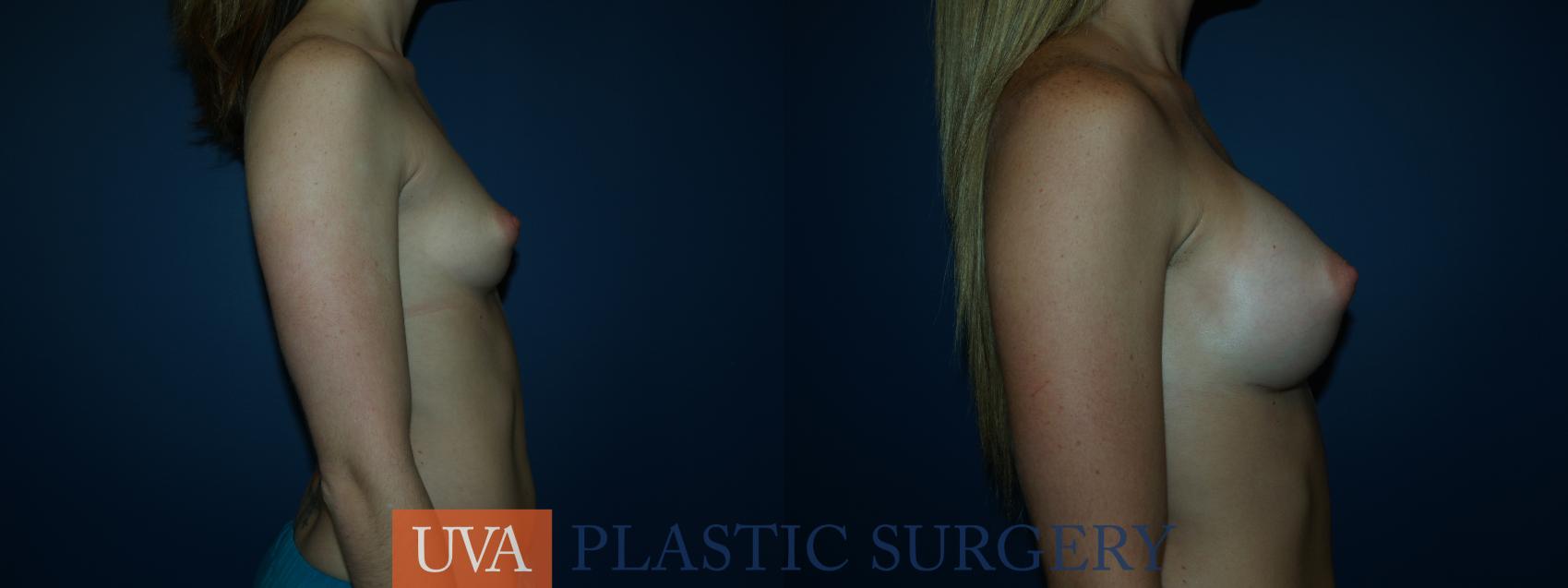 Breast Augmentation Case 37 Before & After View #3 | Charlottesville & Fishersville, VA | University of Virginia Plastic Surgery